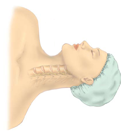 Anterior Cervical Discectomy & Fusion