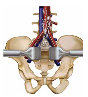 ALIF: Anterior Lumbar Interbody Fusion