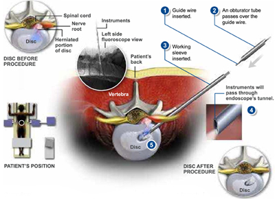 YESS Selective Endoscopic Discectomy™