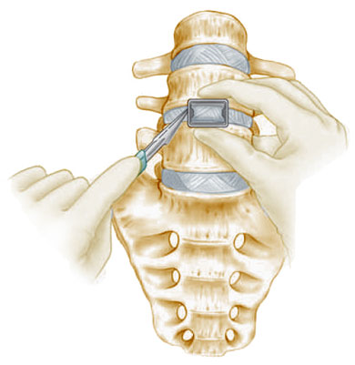 Inserting Graft Inserting Graft