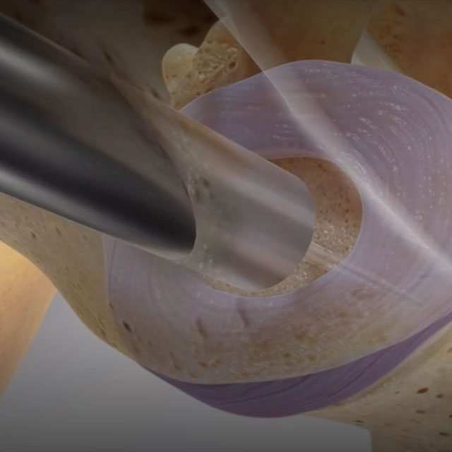 AXIALIF: Axial Lumbar Interbody Fusion
